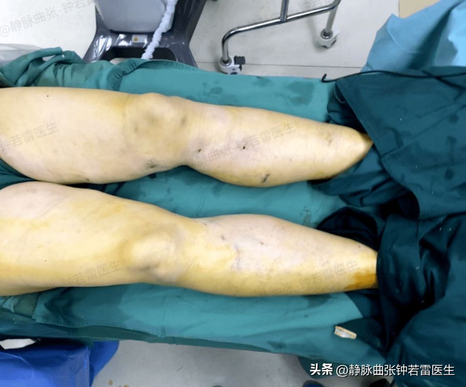 腿弯处有许多红色血管凸起,老年人腿部血管凸起