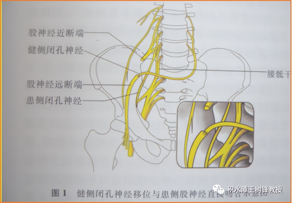 腰骶丛神经为何会受损,骶丛神经损伤