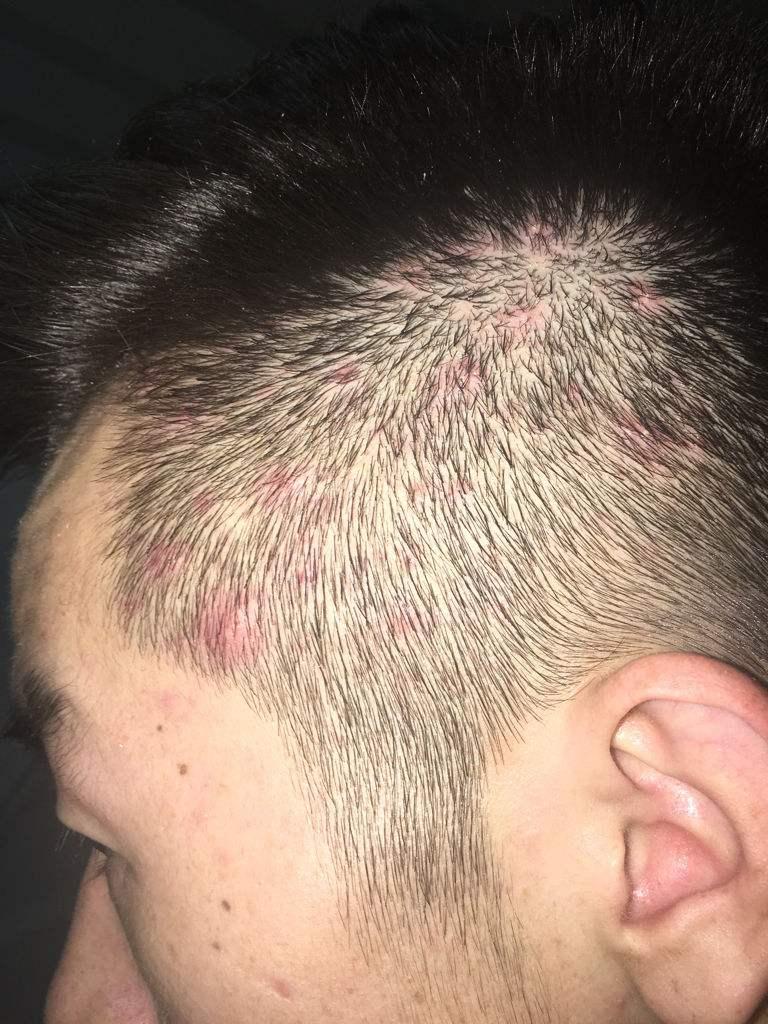 为什么头皮上有小疙瘩和脓包,头皮长疙瘩和脓包是怎么回事