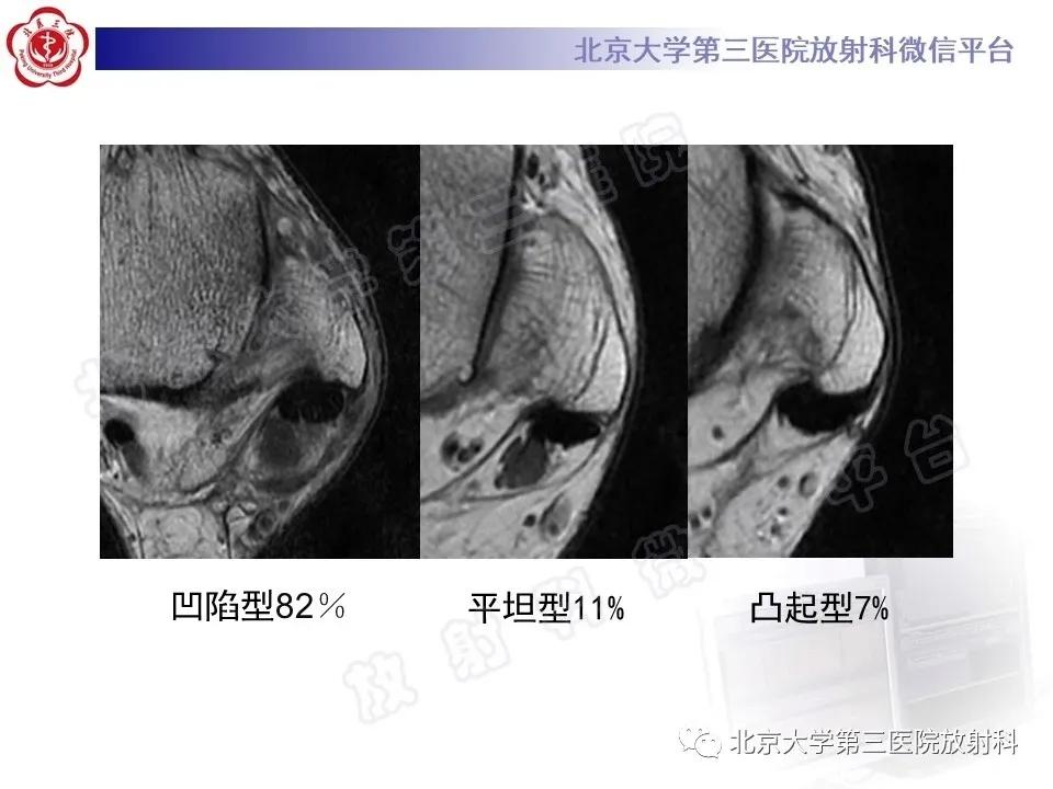 好文分享续集,腓骨肌腱脱位手术价格