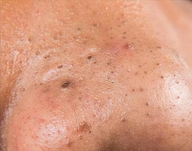 鼻子黑头感觉脏脏的,草莓黑头怎么去除最有效