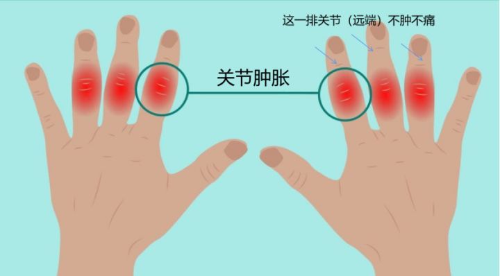 幼儿类风湿性关节炎早期症状,类风湿关节炎早期症状验什么血