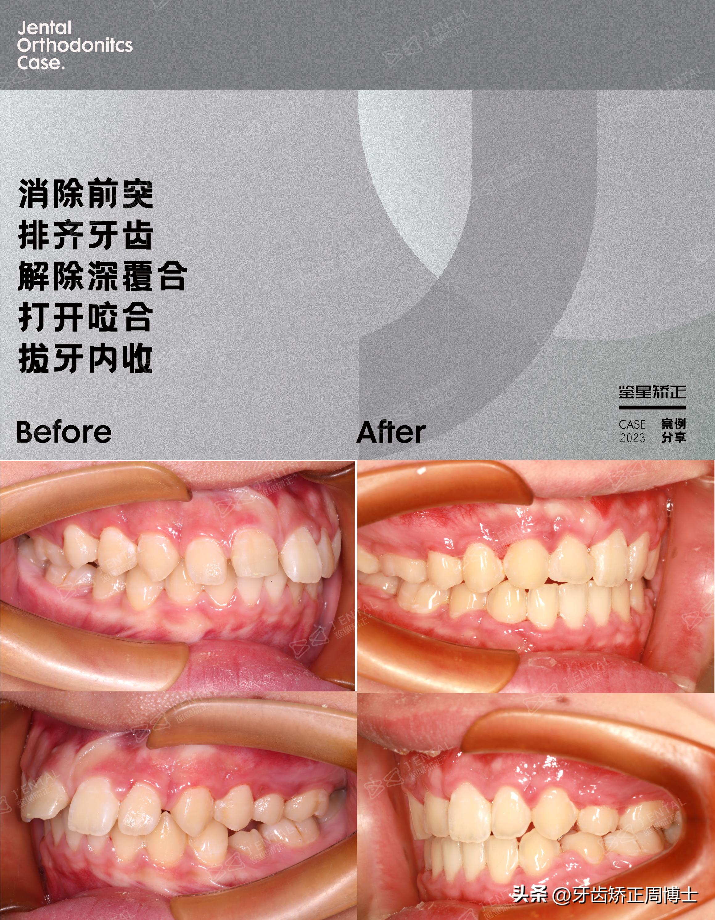 拔掉大牙做矫正好还是植牙好,拔掉4颗牙齿正畸收缝有几种方法