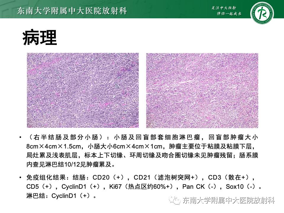 小肠间质瘤最新治疗中药方,小肠间质瘤基因检测