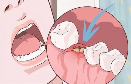 拔完牙医生让口水吞下去,拔完牙齿医生为什么说吞下口水