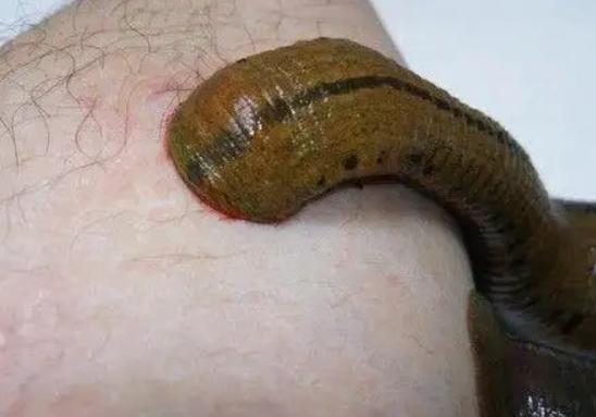 男孩喝生水取出蚂蟥,云南5岁男孩取出蚂蝗