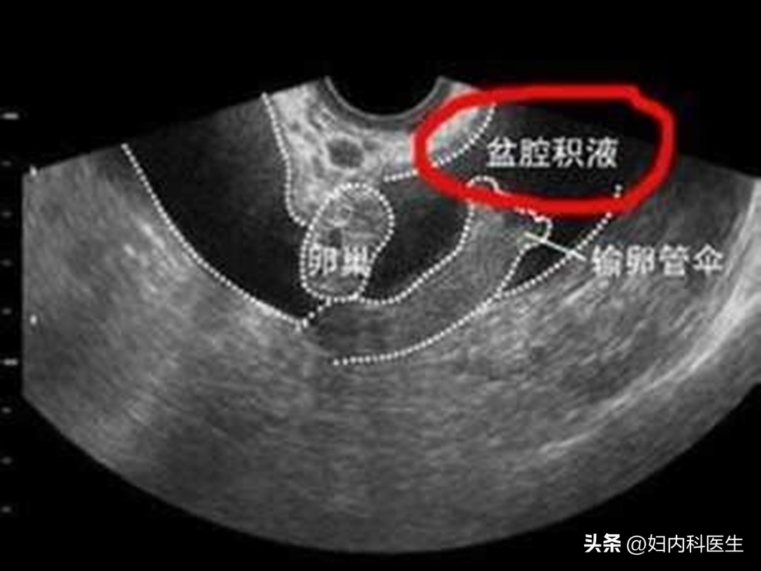 检查出有盆腔积液怎么办,如果查出有盆腔积液怎么治疗