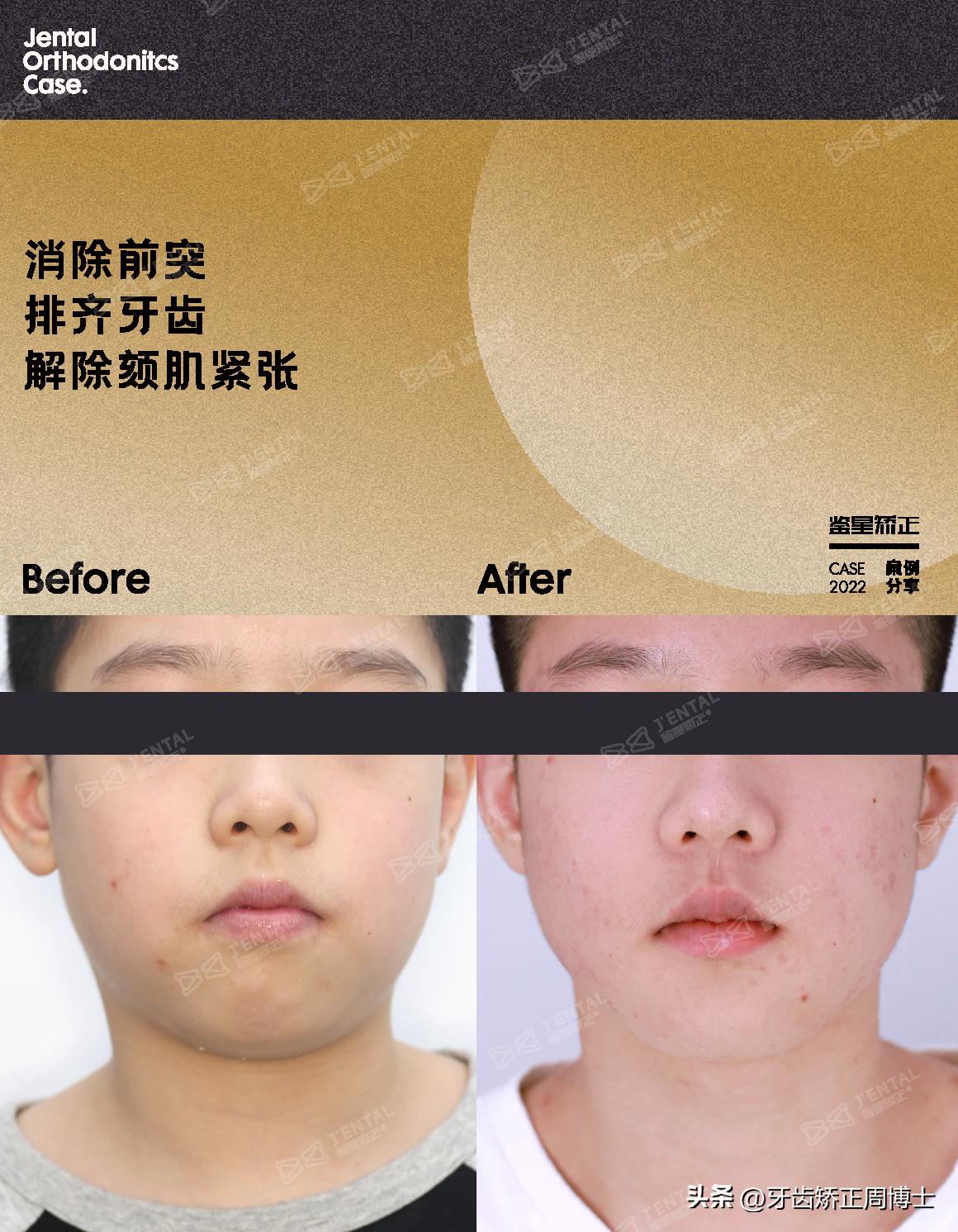 mrc戴上后不能闭上嘴怎么办,mrc矫正能用到几岁