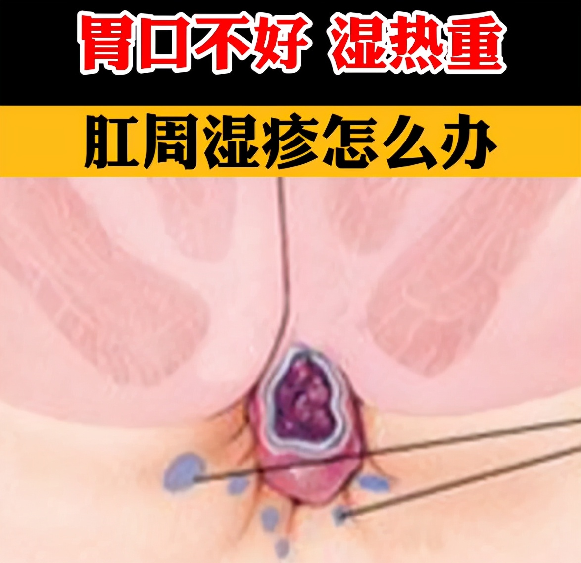 肛周湿疹反反复复如何彻底根除,肛周湿疹反复发作不好怎么办