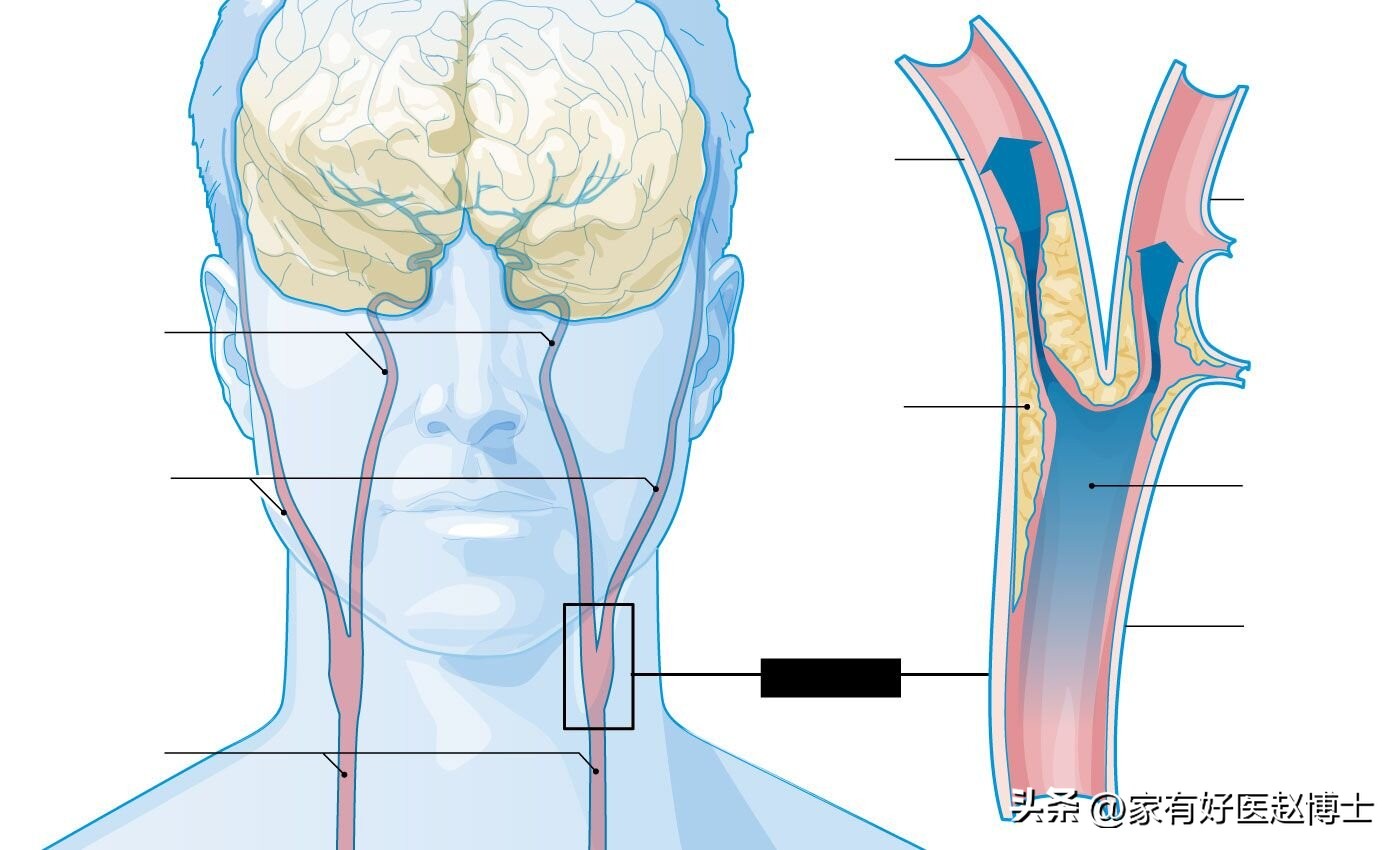 颈动脉没有斑块可以停用他汀吗,一般他汀吃多久颈动脉斑块有效果