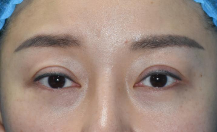 近距离感受五官,双眼皮深肉条凹陷图片