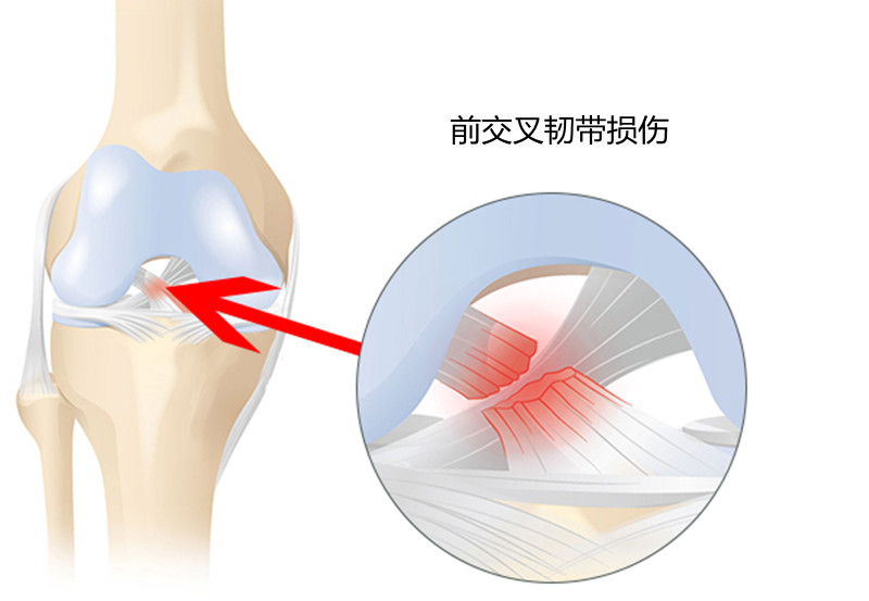 左膝盖不红不肿疼痛什么原因,膝盖内侧肿且疼痛是怎么回事