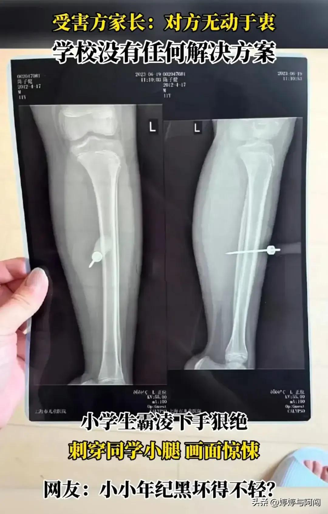 上海男子捅伤小学生,上海小学生钢锥扎进小腿当事人