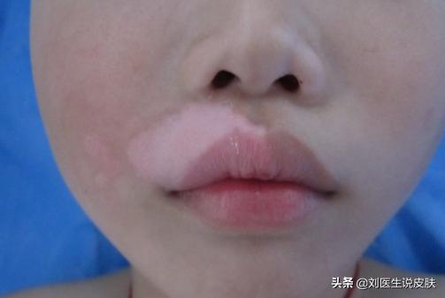 白癜风如何彻底治愈,白癜风怎么治疗才能彻底治愈