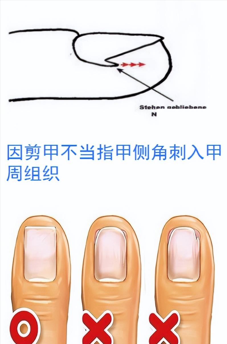 嵌甲疼痛难忍,嵌甲怎么才能有效缓解疼痛