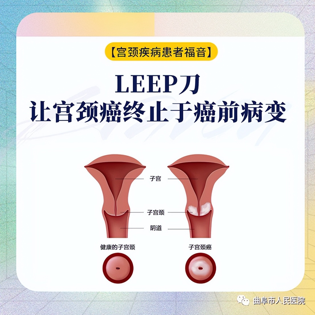 宫颈物理治疗leep刀,宫颈leep刀后病理显示慢性宫颈炎