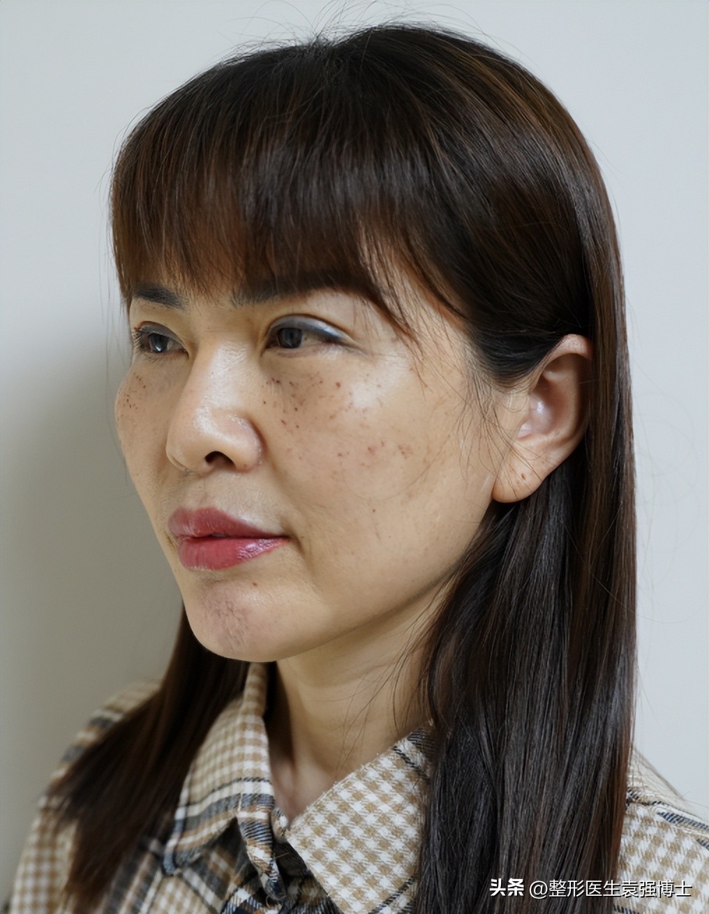 做大拉皮真的显年轻几岁吗,北京做大拉皮前后对比照片图文