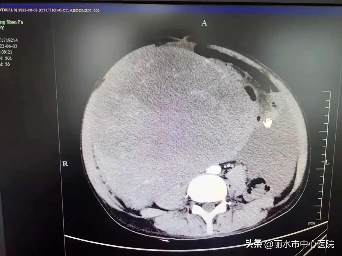 多学科合作治愈腹腔巨大肿瘤
