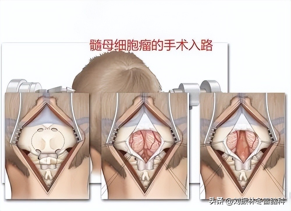 头痛恶心呕吐后缓解,小儿头痛呕吐是怎么回事