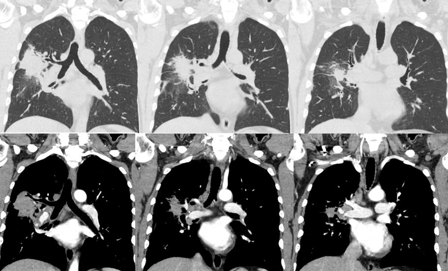 机化性肺炎用药多久复查ct,坠积性肺炎ct表现