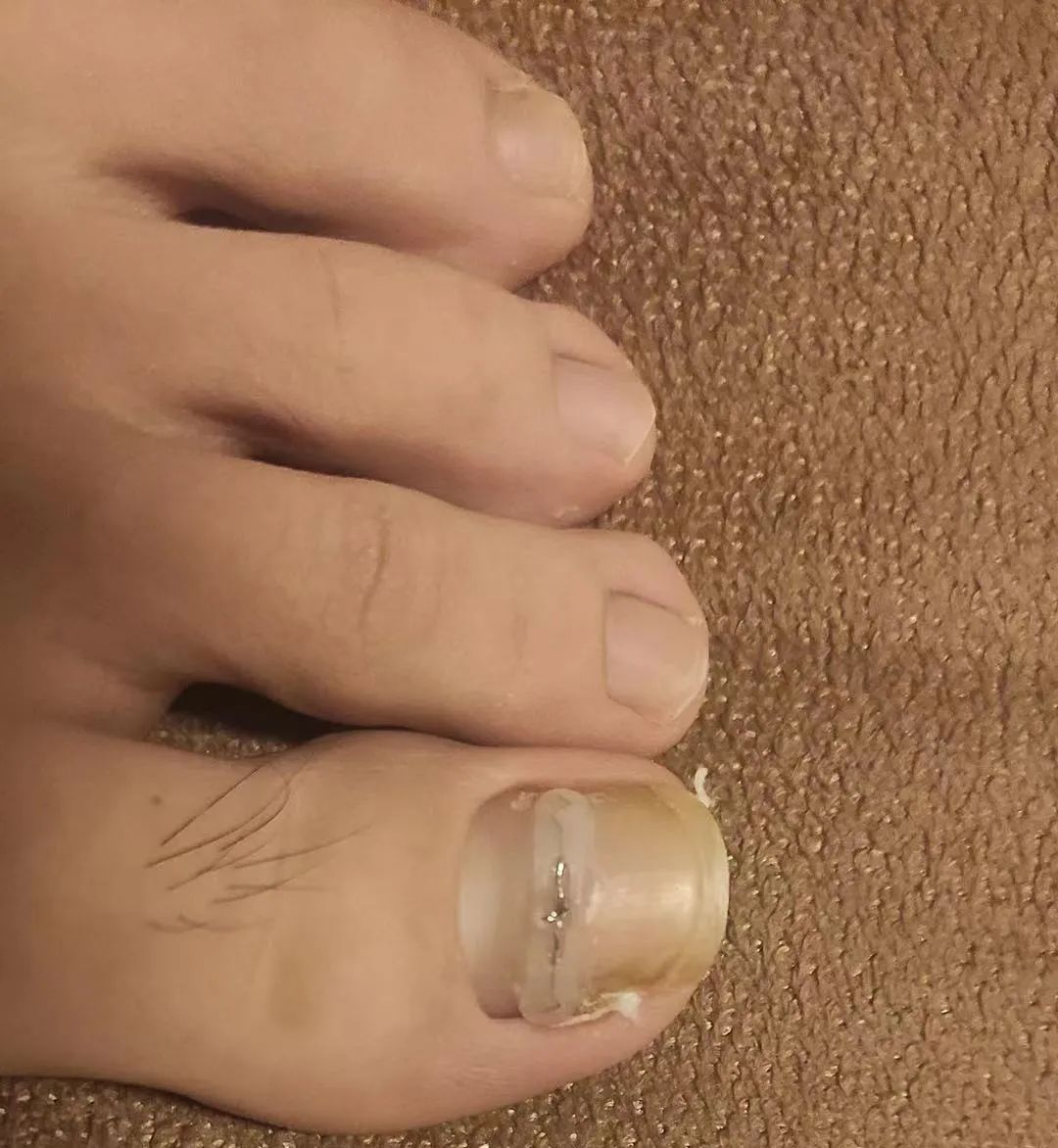 嵌甲疼痛难忍,嵌甲怎么才能有效缓解疼痛