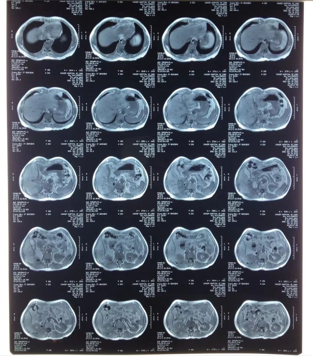 赴美治癌3000天,赴美就医最高花费多少钱
