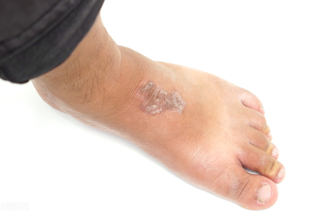 脚气糜烂根治小方法,皲裂瘙痒型脚气中药治疗法