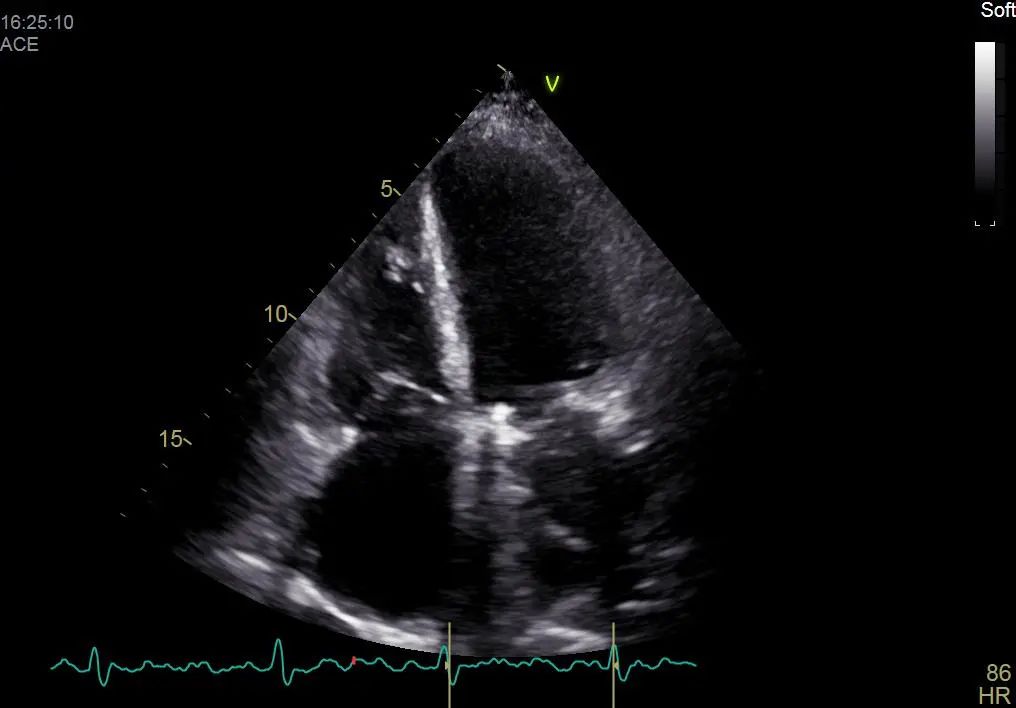 10岁女孩心脏有杂音是怎么回事,她的心脏