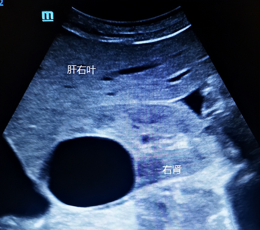 超声介入入门,手把手教你入门超声