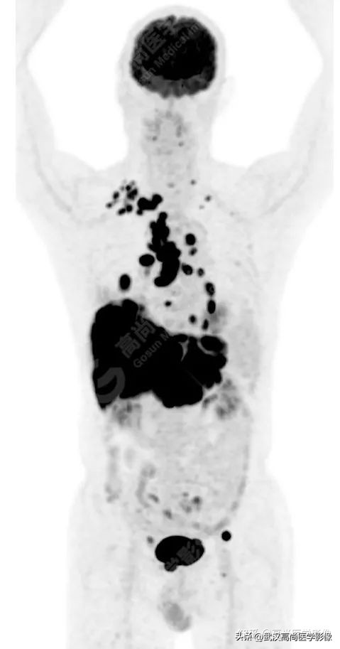 10毫米的肺结节恶性死亡率有多大,1厘米多的肺结节良性可能性多大