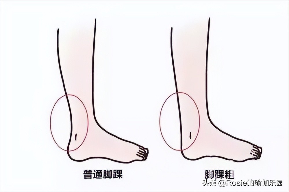 脚踝特别细小腿特别粗怎么瘦,脚踝粗有办法瘦吗