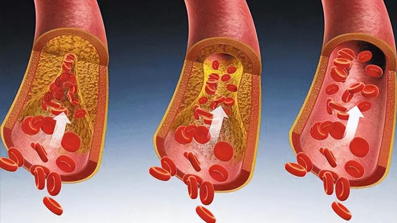 血管有自愈功能吗,血管软化的四大误区