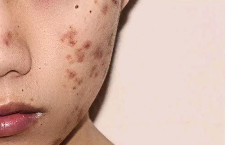 如何有效改善红痘印和黑痘印,白痘印和黑痘印哪个更容易遮盖