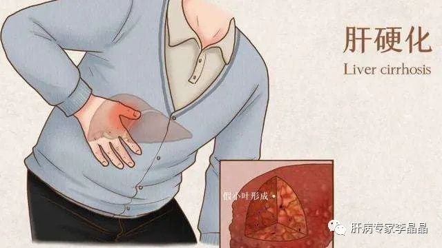 中医调理能治好肝硬化吗,中医治疗肝病肝硬化