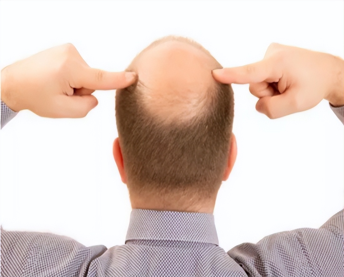 男性雄性激素越旺盛越好吗,男人50岁后雄性激素旺会脱发吗