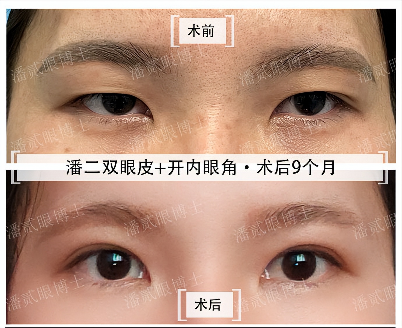 内眦赘皮用手术吗,内眼角内眦赘皮矫正不做手术