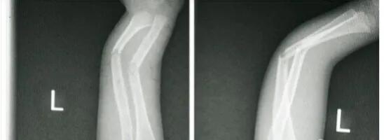 小孩子骨折手术后需要做康复吗,小孩骨折后需要做保护吗