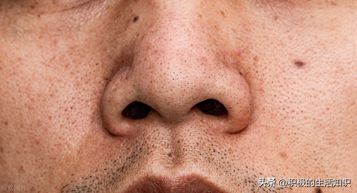 黑头较严重的用什么方法去除,黑头要怎么对付