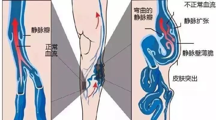 跷二郎腿静脉曲张怎么治,静脉曲张跷二郎腿有好处吗