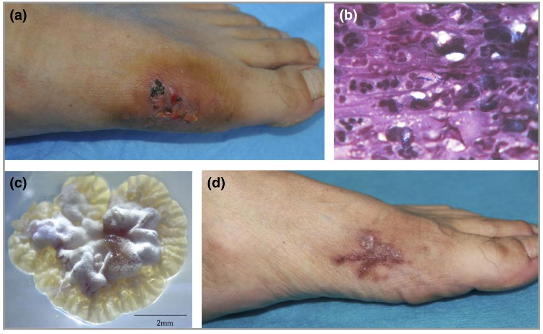 这种新的致病菌被命名为“华西诺卡菌”
