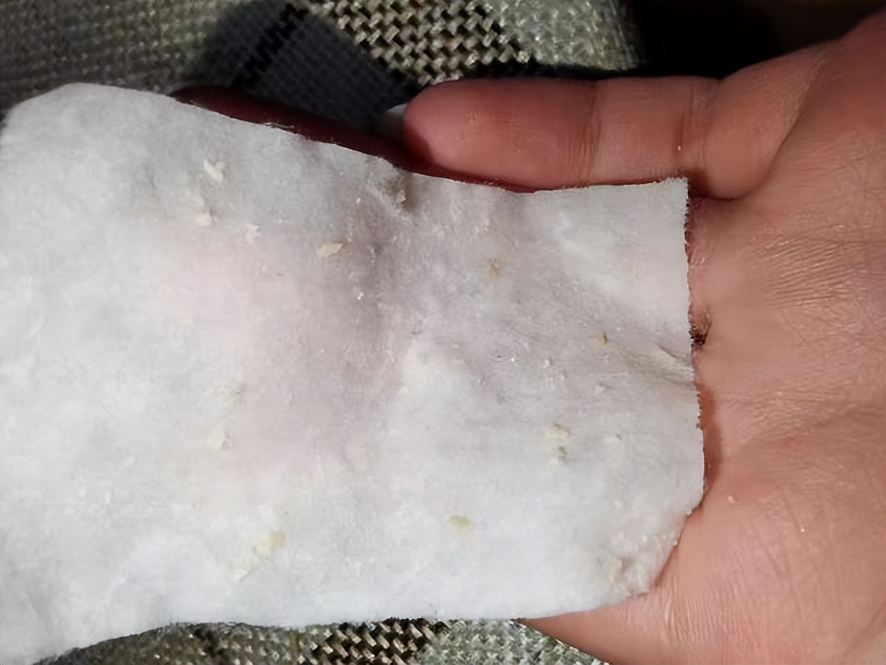 鼻头长黑粉刺怎么回事图片,鼻梁及两侧起了闭口粉刺