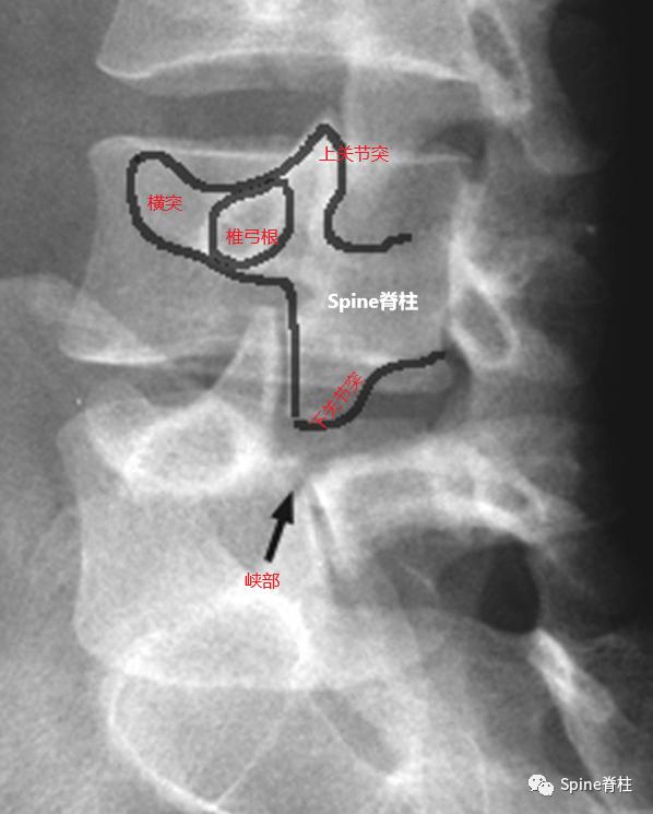 峡部裂和隐性峡部裂有区别吗,单纯峡部裂可以做峡部修复吗