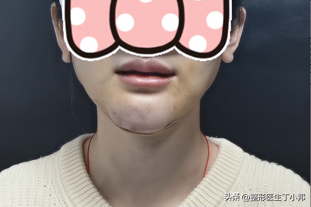 取出下巴生长因子后，异常增生怎么办？#丁小邦注射物取出#科普