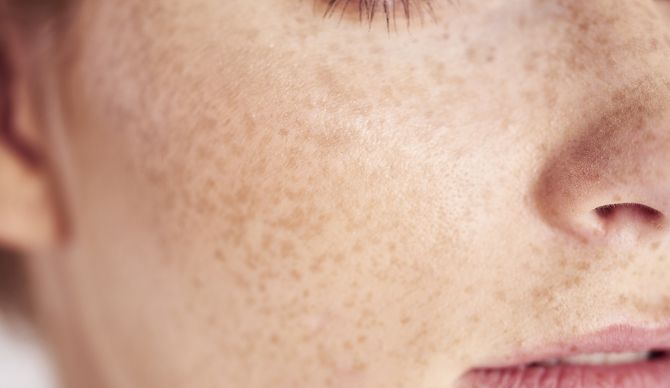 祛斑全攻略让肌肤莹白又透亮,有效祛斑的小方法有哪些呢