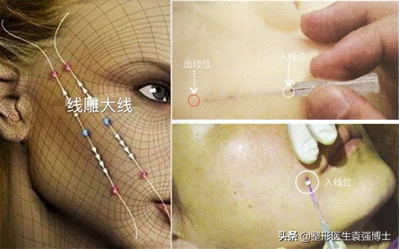 脸下垂有法令纹怎么办,经常耷拉的脸容易长法令纹