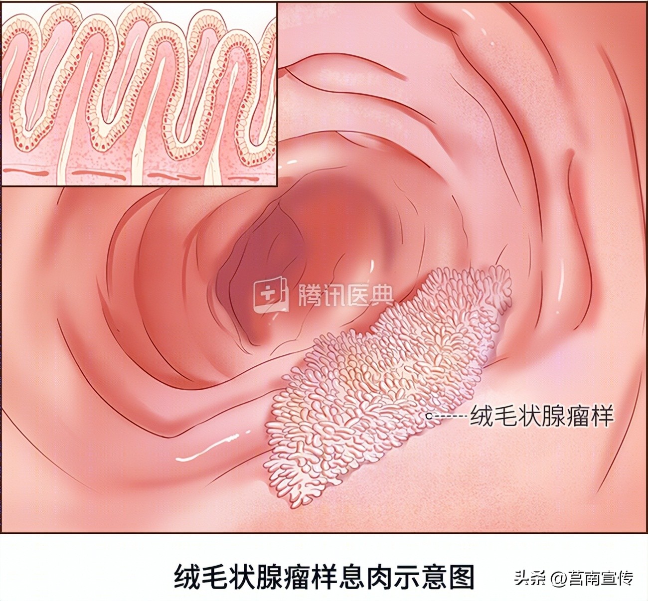 发现息肉，离癌有多远？