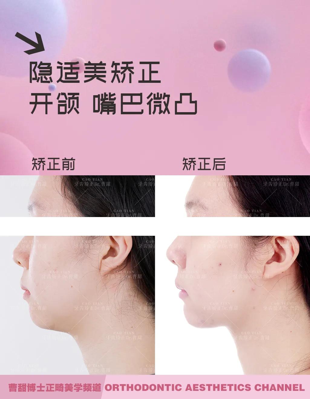 上下牙无法咬合是怎么回事,30岁牙齿咬合开颌还有必要矫正吗