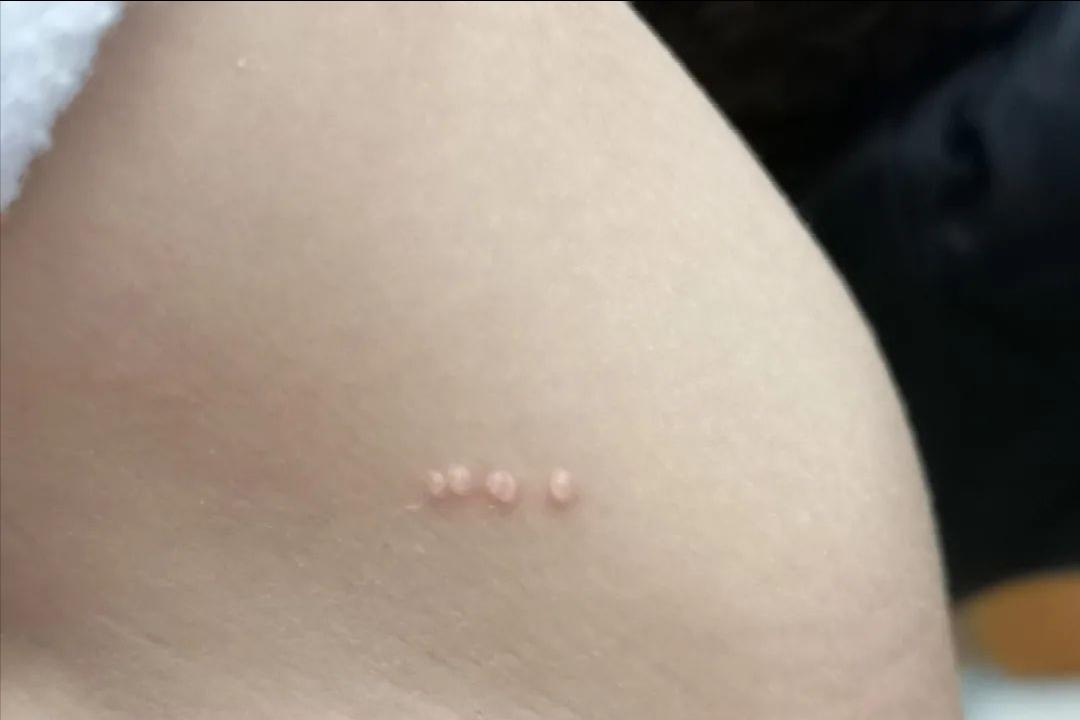 hpv和疣是一种病吗,hpv病毒疣是什么样的