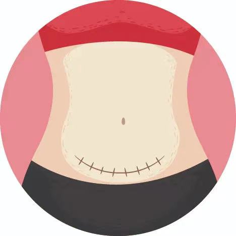 剖宫产疤痕如何看是恢复的比较好,剖宫产疤痕憩室怎么去除