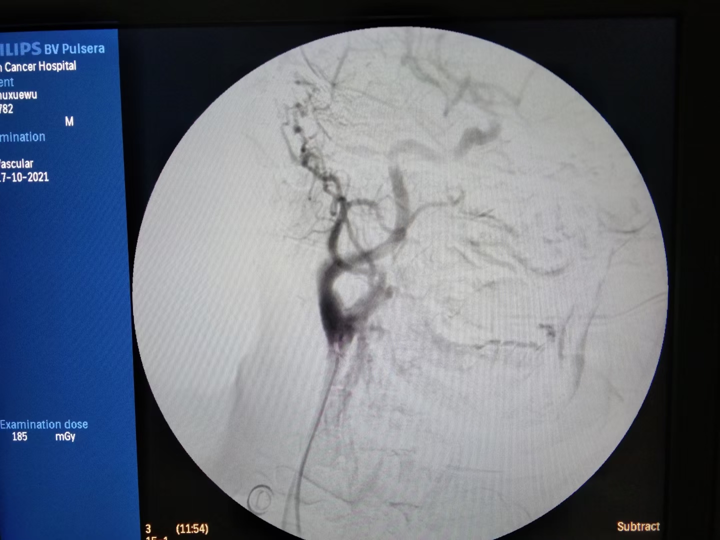 「病例分享」舌癌患者突发大出血，燥动不安，介入治疗成功止血